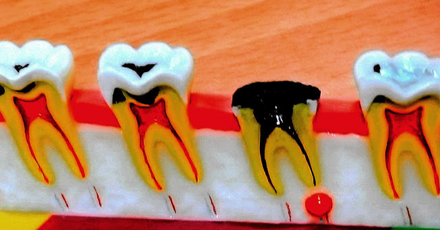 枝幹與牙髓根管系統