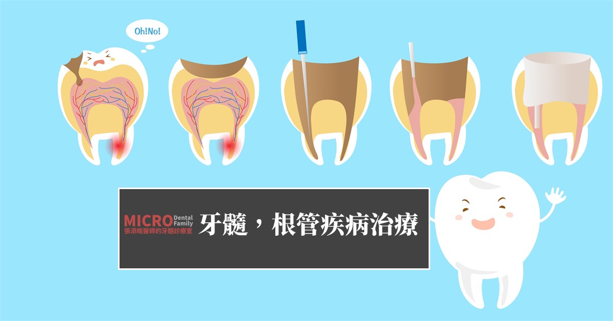 牙髓，根管疾病治療