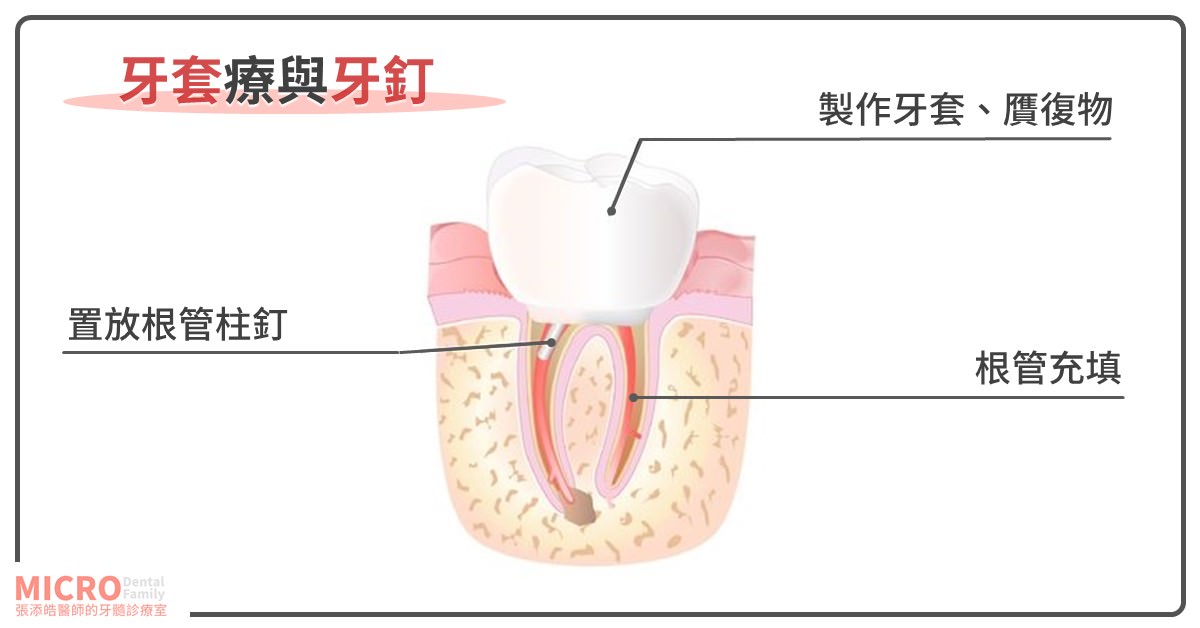 牙齒裡面居然有棉花？這根管治療〈抽神經〉是豆腐渣工程嗎？(2020/10更新)