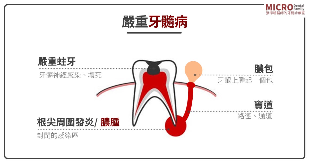 你知道氣壓性牙痛嗎？坐飛機、爬山、潛水有牙痛時，絕對不要拖到要拔牙時才去找牙醫(2022/01更新)