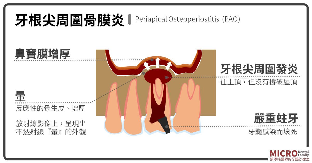 牙根尖周圍骨膜炎Periapical Osteoperiostitis (PAO)
