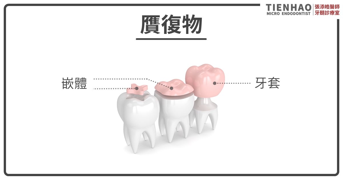 齒雕、嵌體、覆蓋體(overlay)、牙冠(crown)