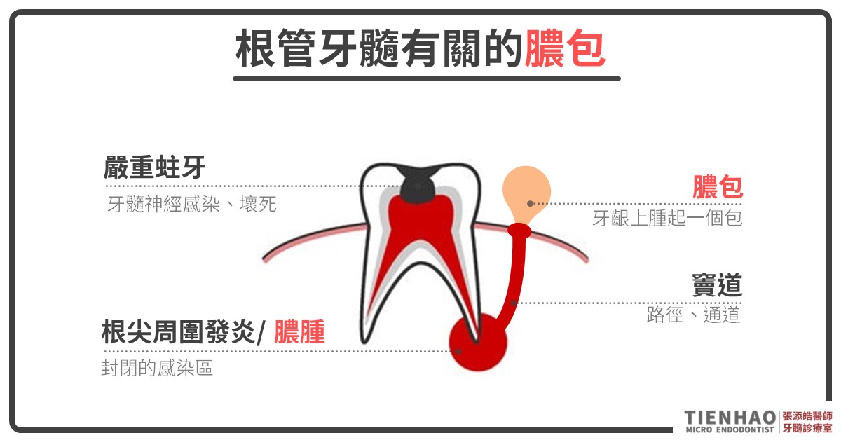 牙肉腫長膿包