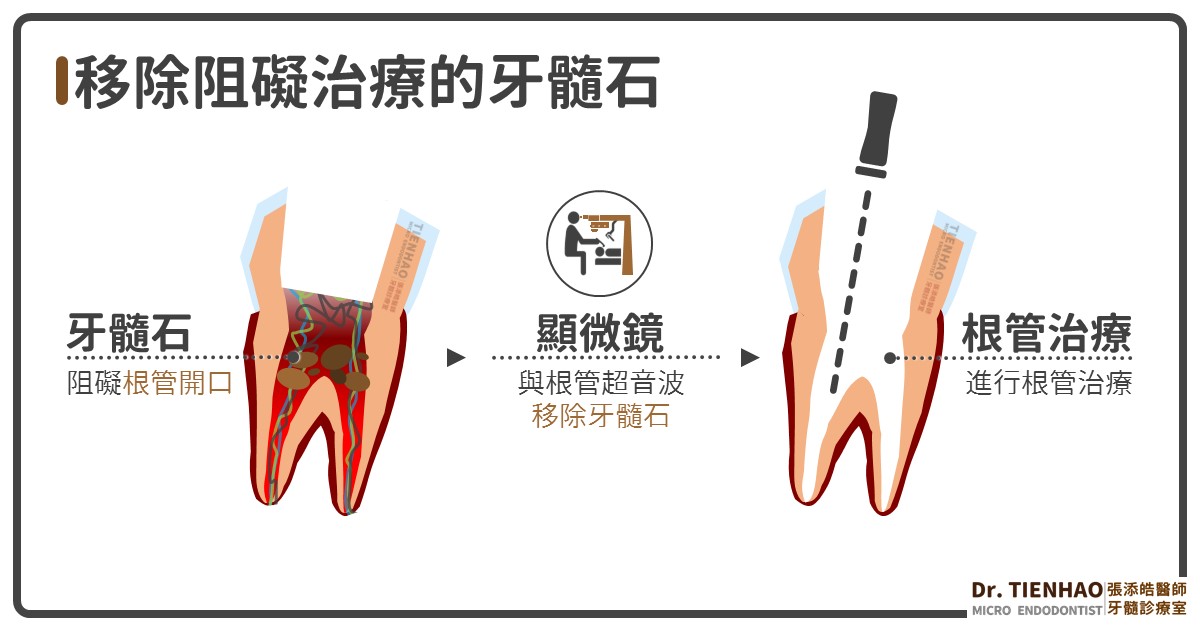 原來牙齒裡面也會結石呀！你聽過牙髓石嗎？與根管鈣化有什麼關係？(2022/02更新)