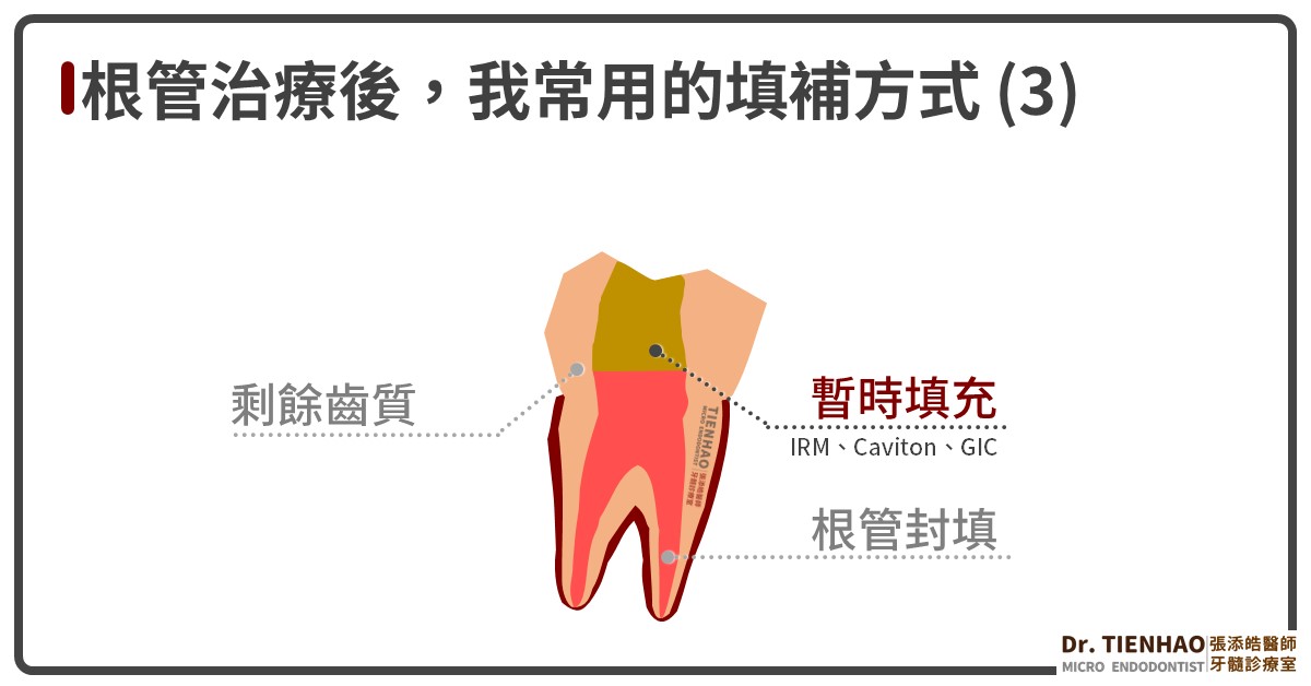 7個問題回答你：為什麼根管治療〈抽神經〉後，補的牙齒下面居然是暫時填補物？