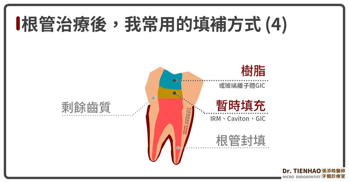 7個問題回答你：為什麼根管治療〈抽神經〉後，補的牙齒下面居然是暫時填補物？