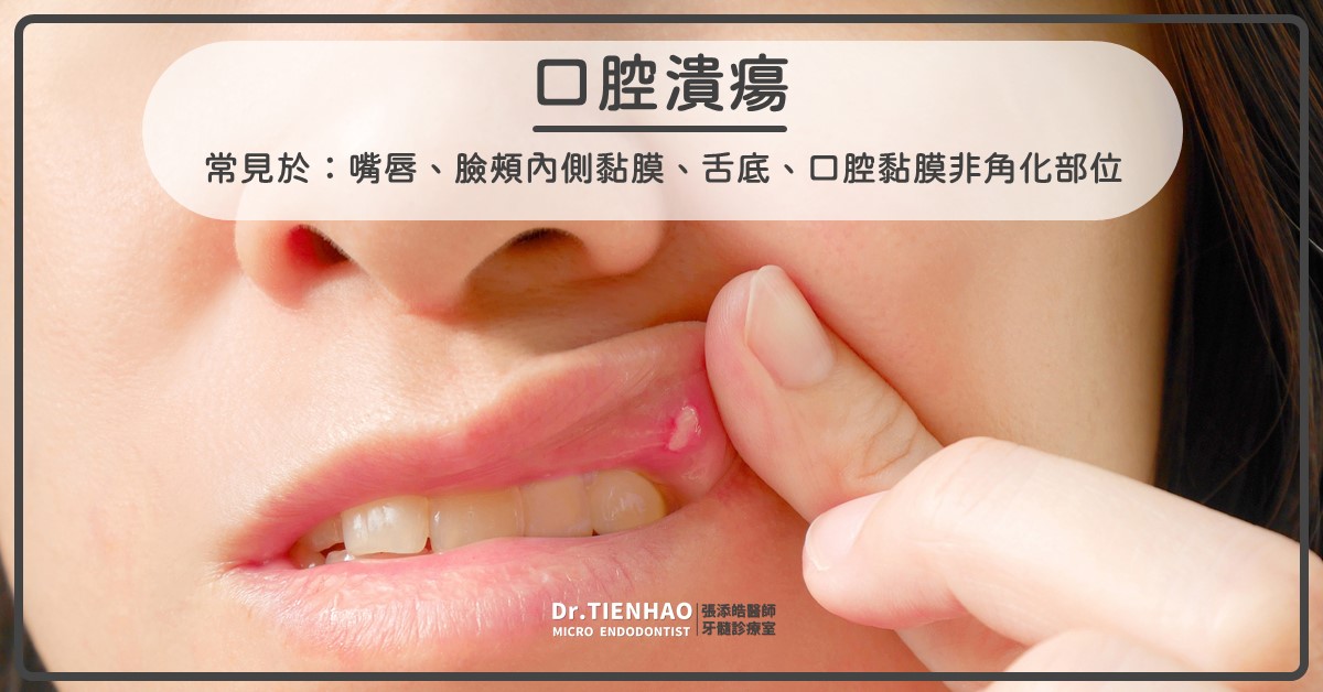 口腔潰瘍、唇皰疹、腸病毒。出現牙科常見的三大嘴破時，可以根管治療或根管手術嗎？