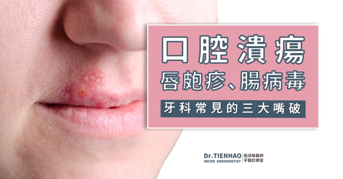 口腔潰瘍、唇皰疹、腸病毒。出現牙科常見的三大嘴破時，可以根管治療或根管手術嗎？