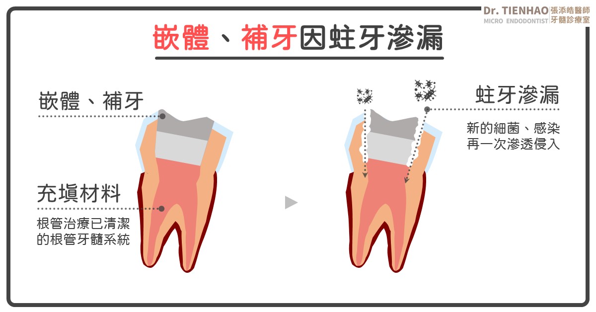 根管治療後的牙齒還會蛀牙嗎？做了假牙牙套、或3D齒雕，為什麼還會蛀牙？三種簡單方式教你遠離牙齒抽神經後還會蛀牙的窘境