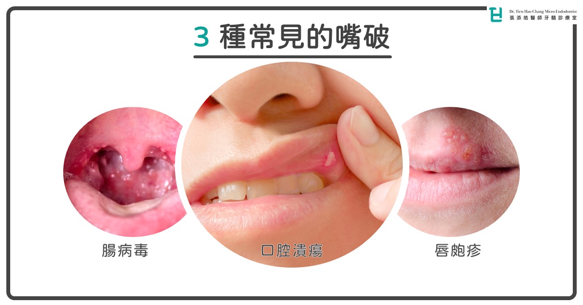 口腔潰瘍、唇皰疹、腸病毒。牙科常見的三大嘴破