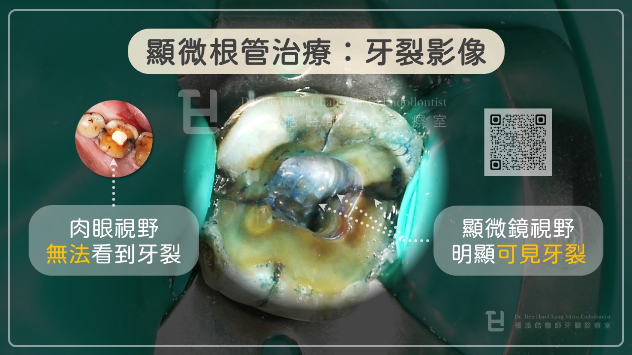 牙裂之顯微根管影像