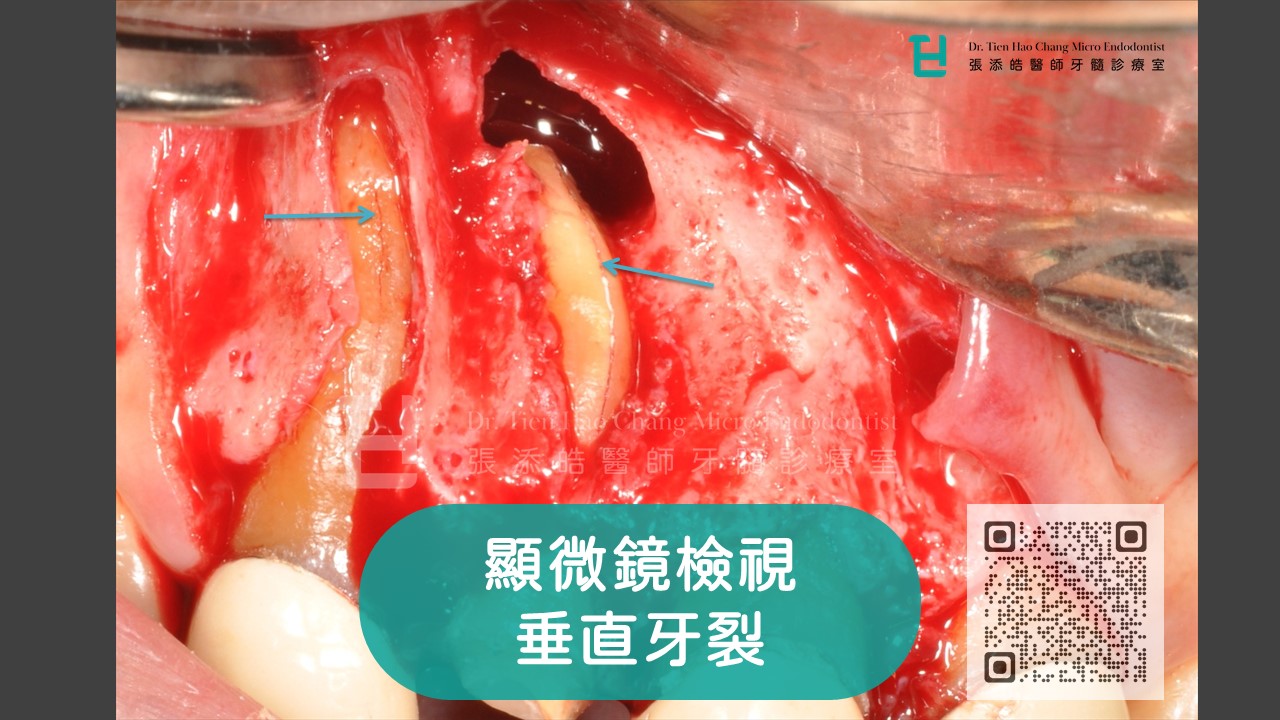 張添皓在顯微根尖手術時，發現病人側門牙以及犬齒有垂直牙根縱裂