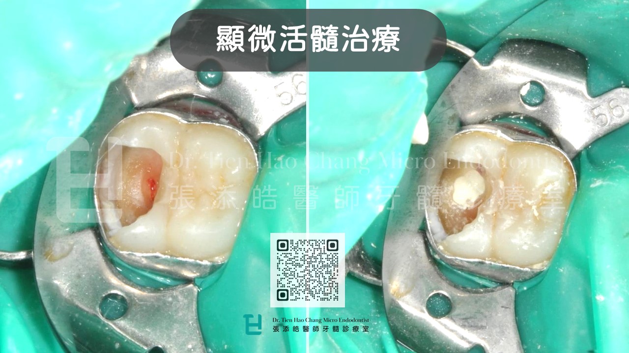 張添皓在台北、新竹、竹北活髓治療，使用使用顯微鏡移除蛀牙，與置放生物材料