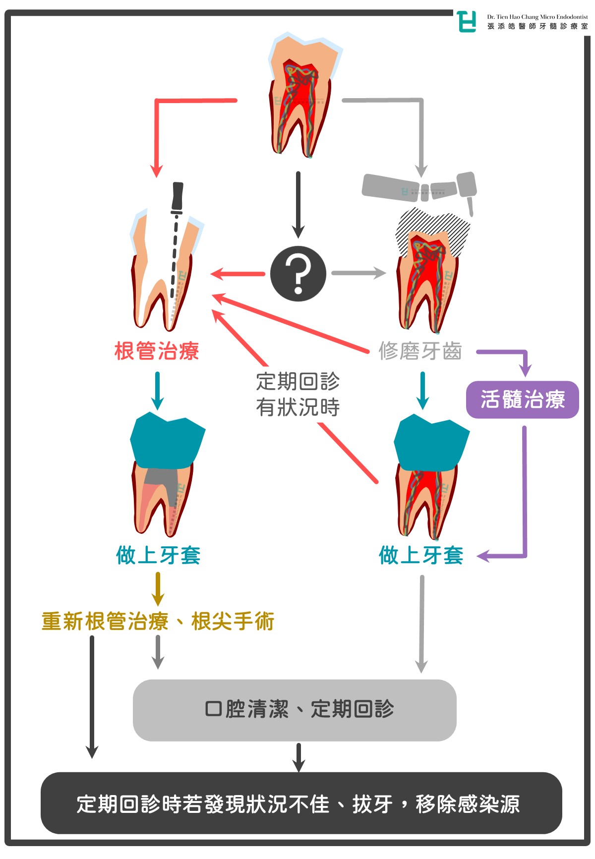 做牙套、牙橋、假牙，一定要先抽神經、根管治療嗎？3階段前中後告訴你，醫師在想什麼？！(2022/02更新)