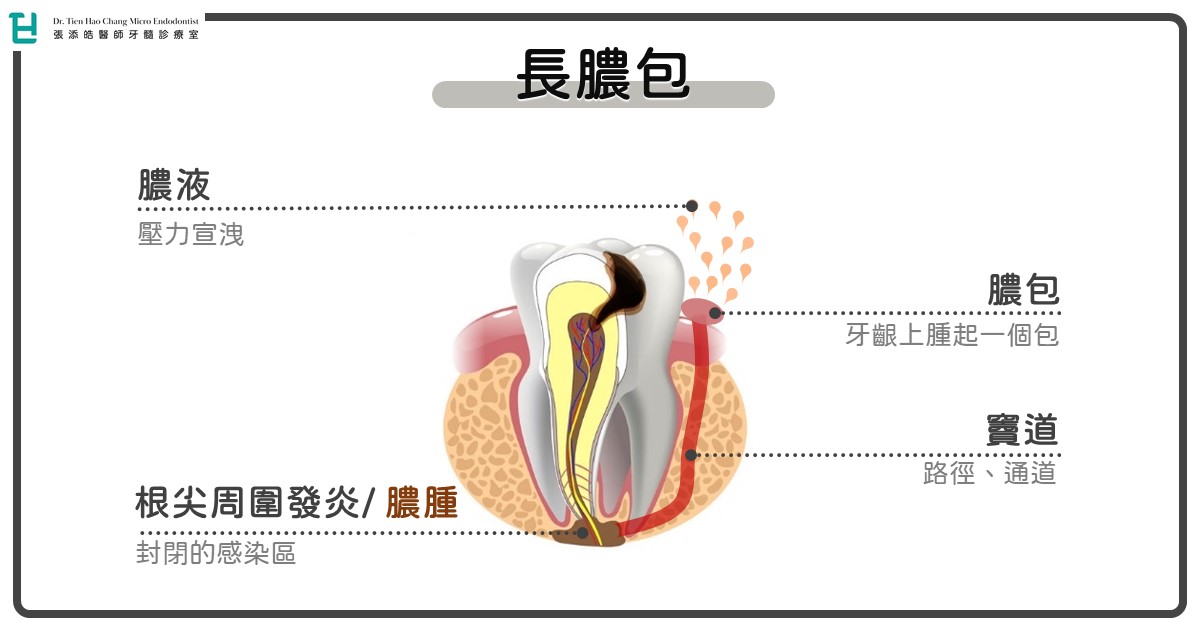 蛀牙長膿包