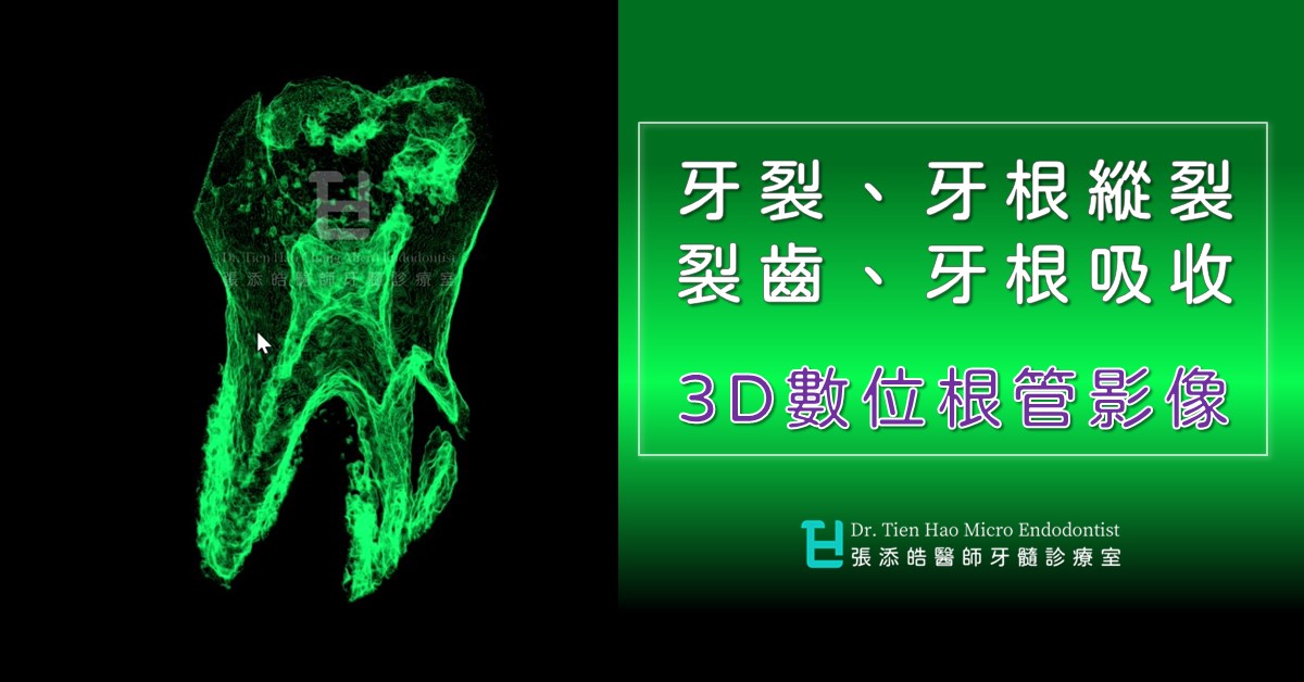 牙裂、牙根裂、裂齒、牙根吸收的3D數位根管影像(01)