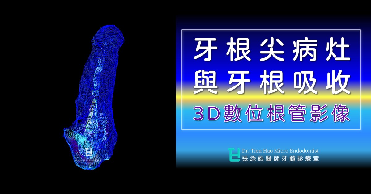 牙根尖病灶、與牙根吸收的3D數位根管影像(02)