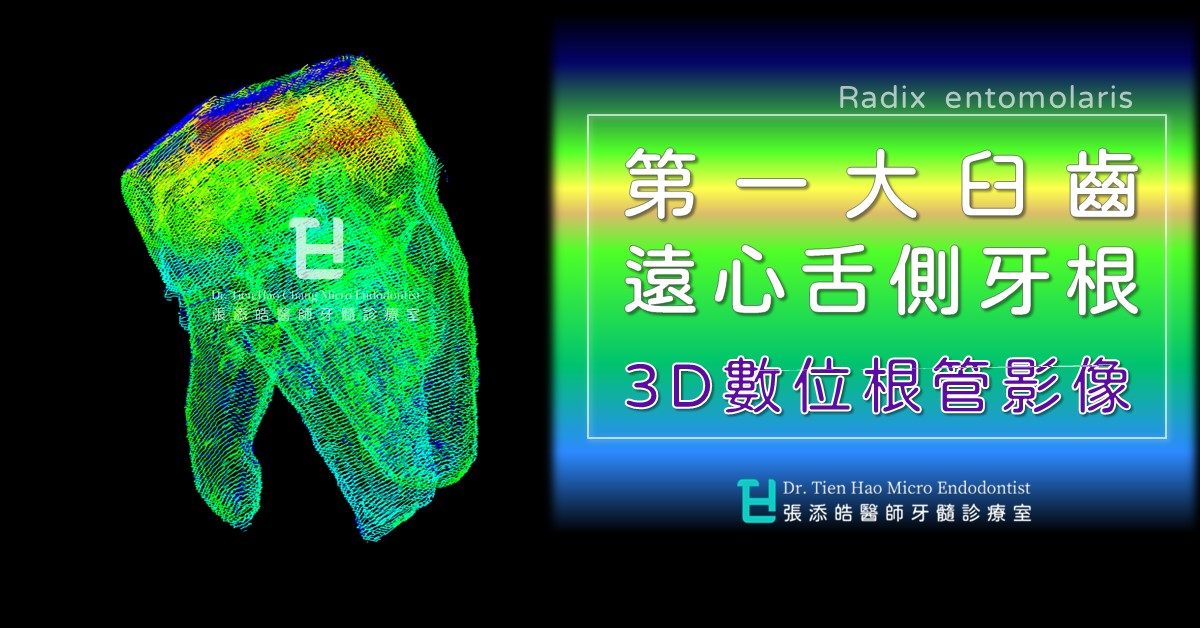 多了那麼一根，第一大臼齒遠心舌側牙根 Radix entomolaris。3D數位根管影像(04)
