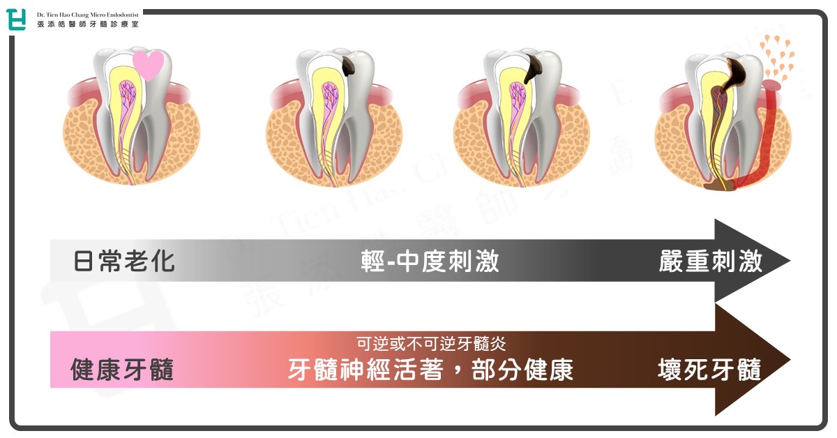 牙髓〈根管、牙神經〉侵犯流程與機制