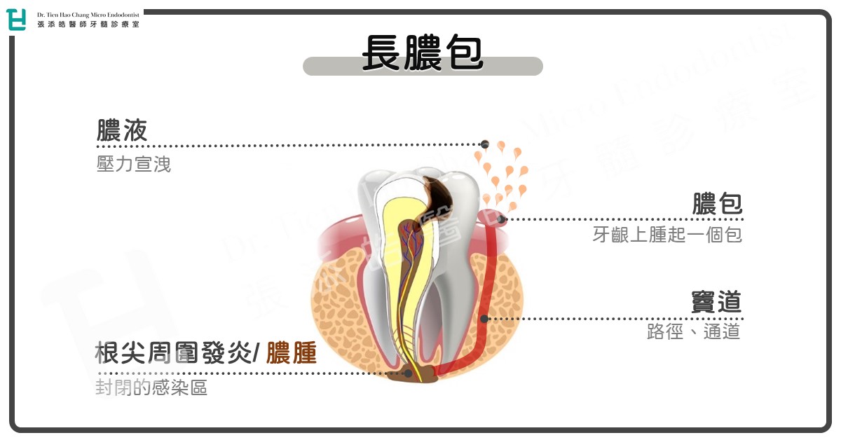 牙齦長膿包顯微根管治療張添皓