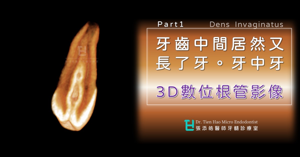 牙齒中間居然又長了牙齒，牙中牙，Dens Invaginatus。3D數位根管影像(05)