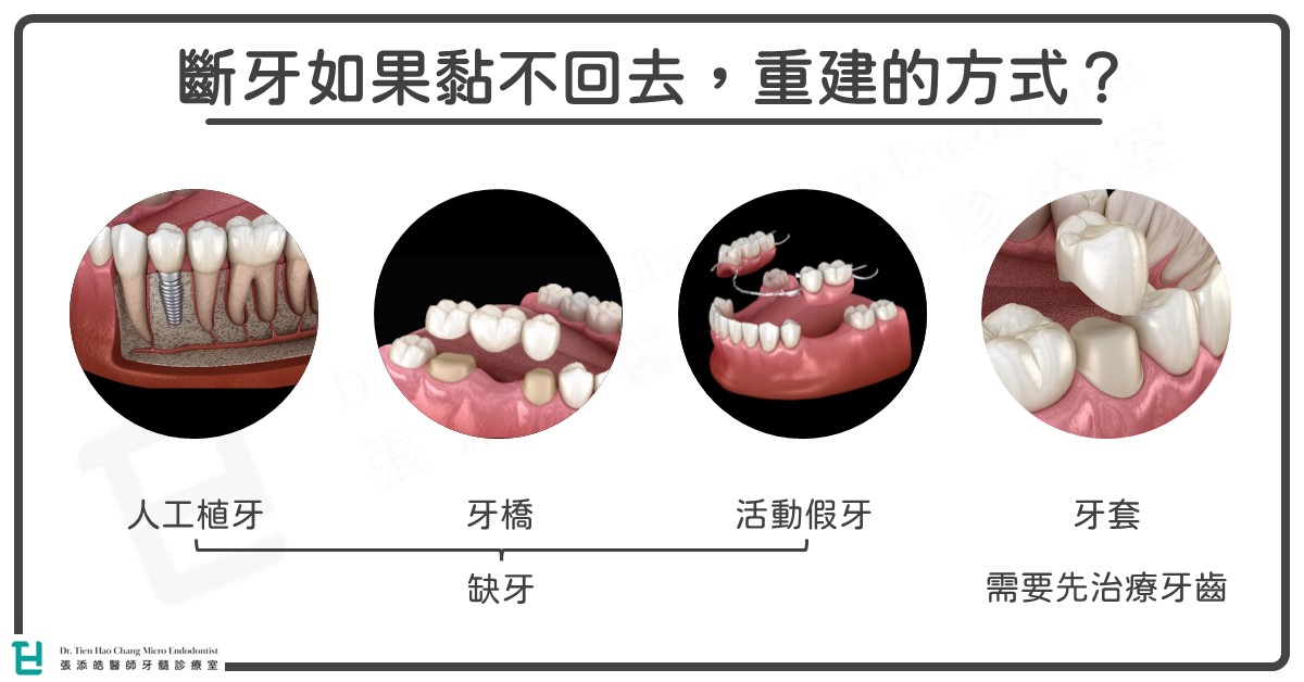 整顆牙齒掉出來、或斷牙如果黏不回去，有哪些牙齒重建的方式？