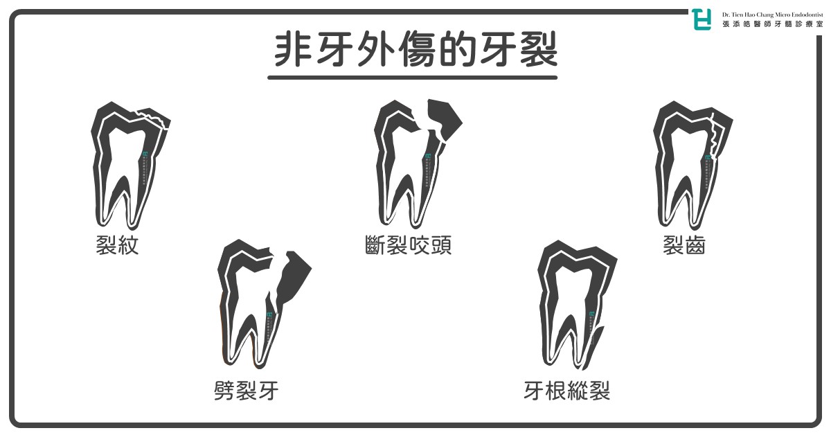 牙齒外傷「較沒關係」的牙裂、裂齒、齒裂。