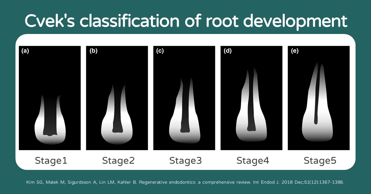Cvek's classification of root development