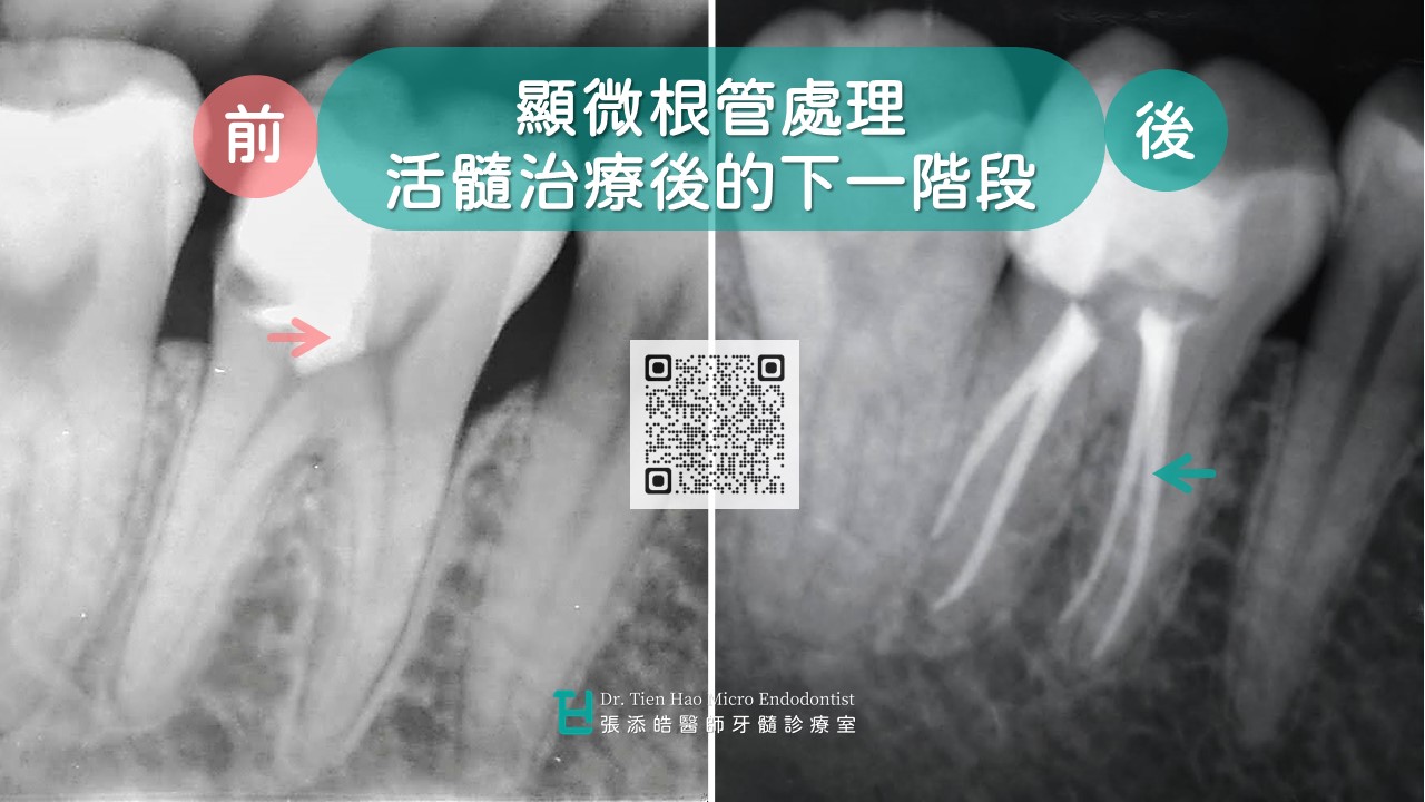 活髓治療後牙肉腫起來、牙齦長膿包？下一階段顯微根管治療。