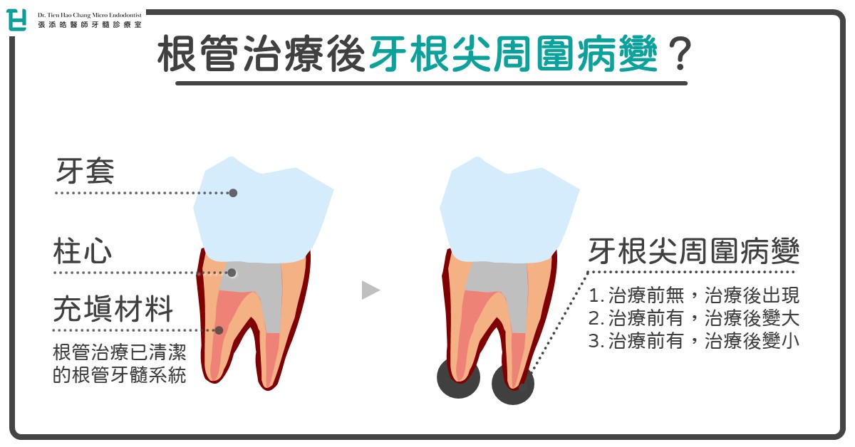 張添皓醫師顯微根管，根管治療後的牙齒，牙根尖黑影可以不治療嗎？