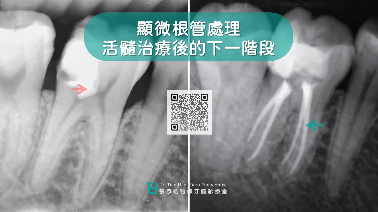 活髓治療後牙肉腫起來、牙齦長膿包