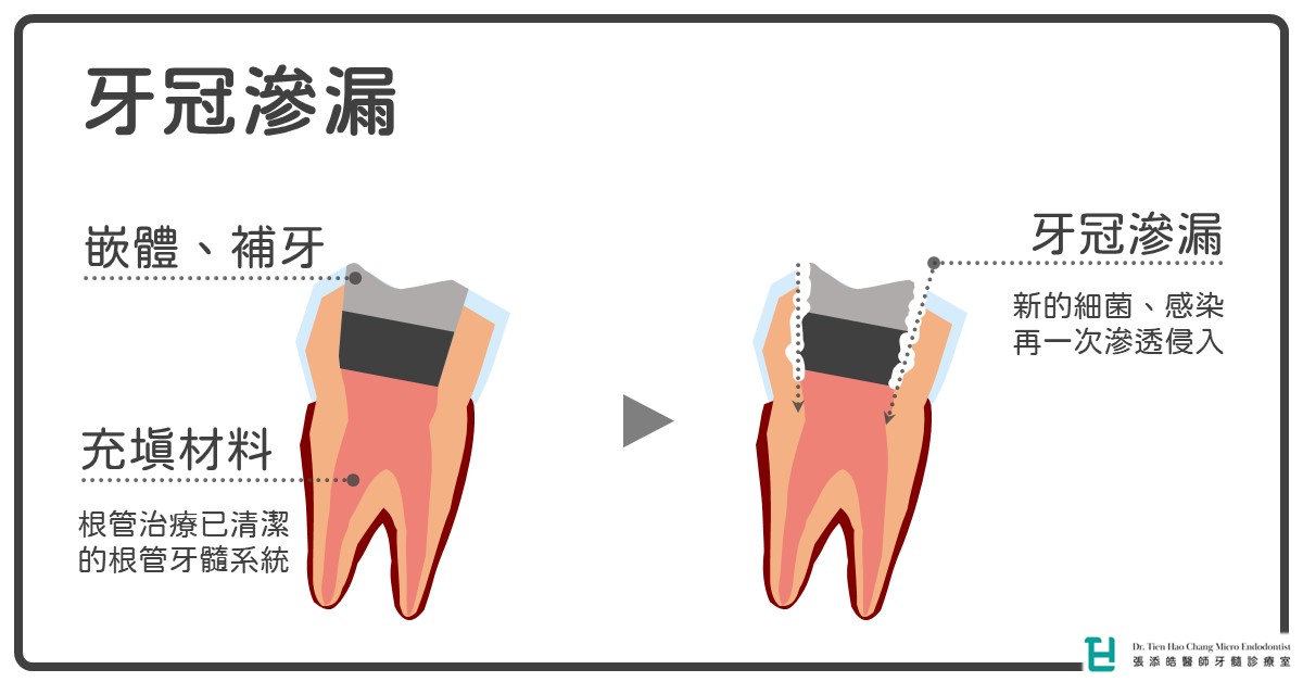 為什麼抽神經後的牙齒要做假牙牙套？