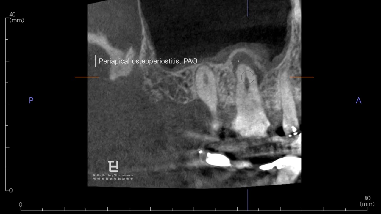 圖2：periapical osteoperiostitis, PAO