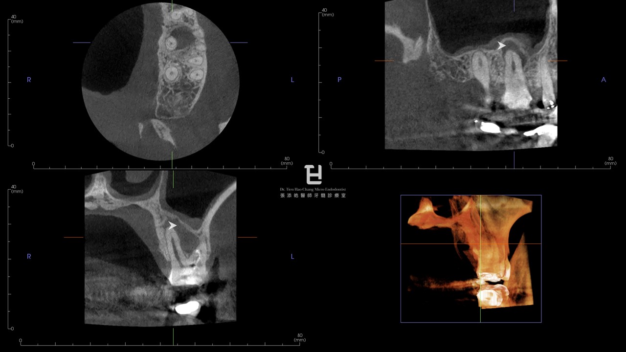 圖3：左上第一大臼齒Previously initiated therapy, symptomatic apical periodontitis。CBCT影像顯示Periapical osteoperiostitis 的影像，箭號。