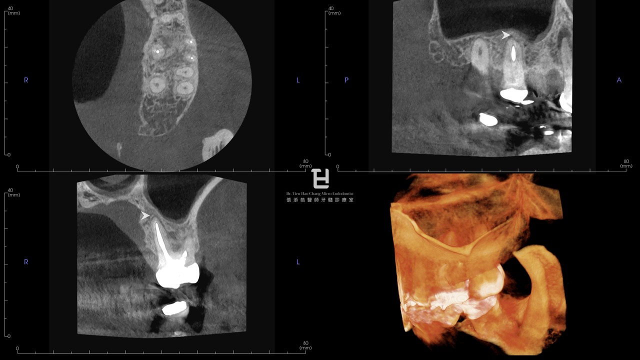 圖4：追蹤一年後，左上第一大臼齒CBCT影像顯示現，原本的PAO已經幾乎完全癒合，箭號。