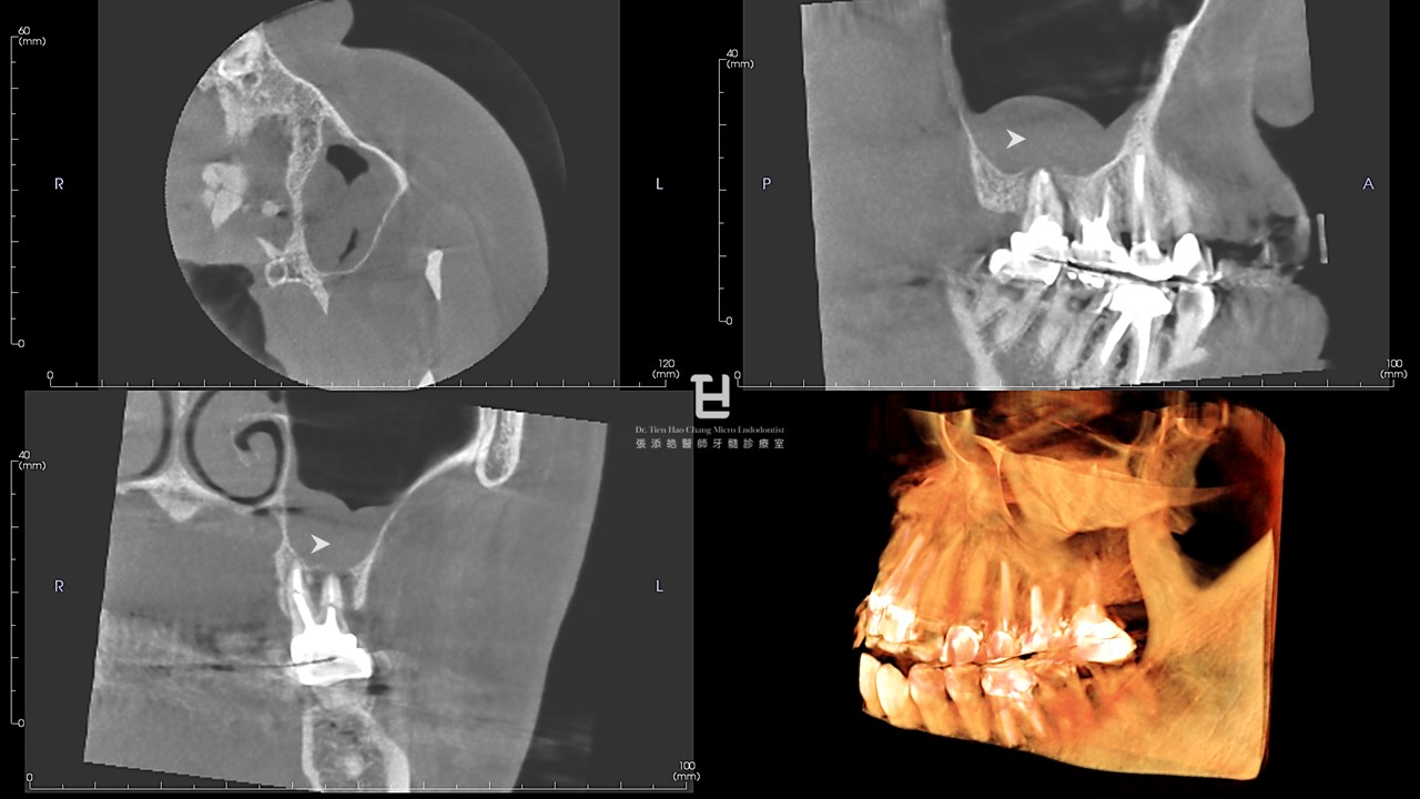 圖5：左上第一大臼齒Previously Treated, symptomatic apical periodontitis R/O vertical root fracture。CBCT影像顯示Periapical mucositis, PAM 的影像，箭號。