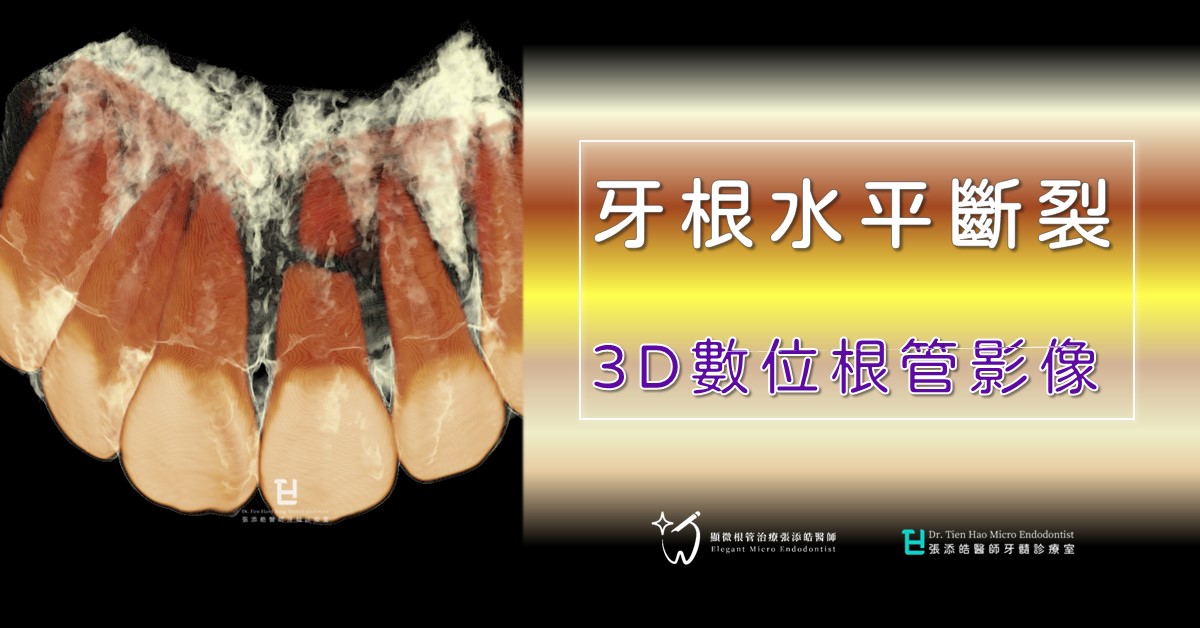 牙根水平斷裂，你擔心嗎？3D數位根管影像(14)內含影片