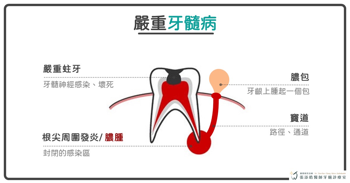 牙齦膿包、牙齦腫、牙肉上的膿包