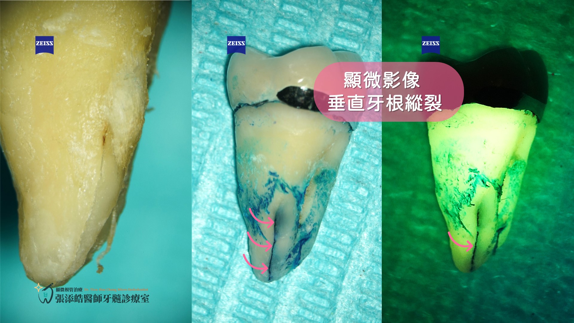 垂直牙根縱裂顯微根管治療