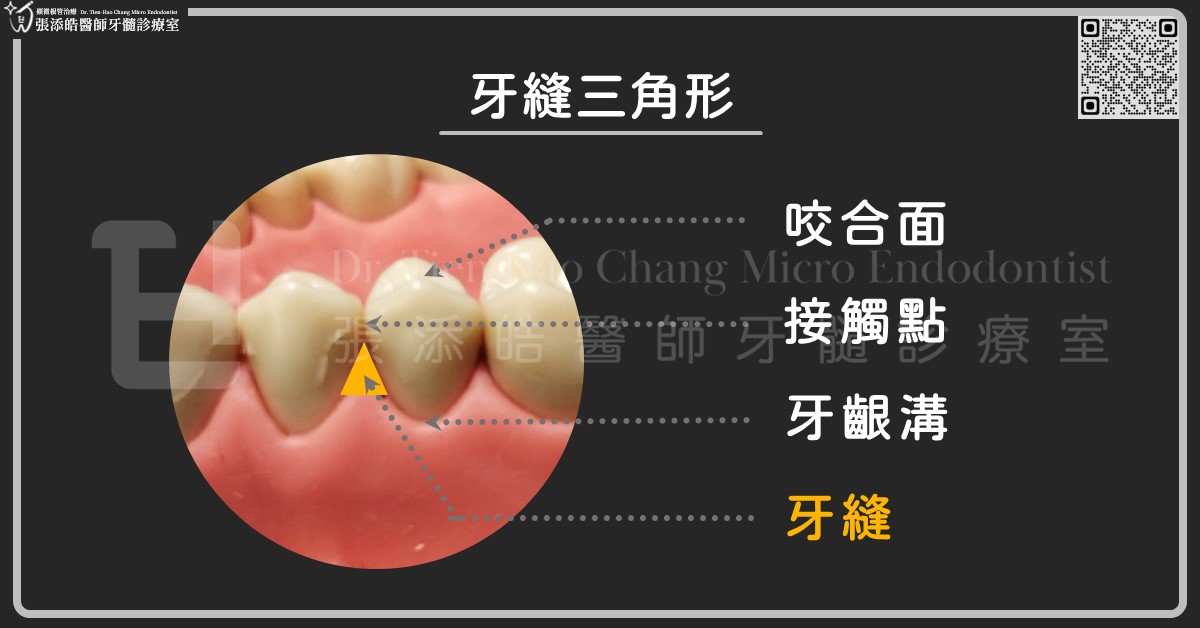 牙縫蛀牙，必用牙線、牙間刷新竹顯微根管治療張添皓牙縫蛀牙