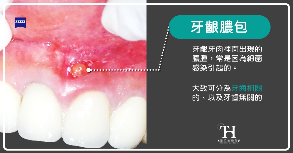 牙齦膿包，張添皓顯微根管治療