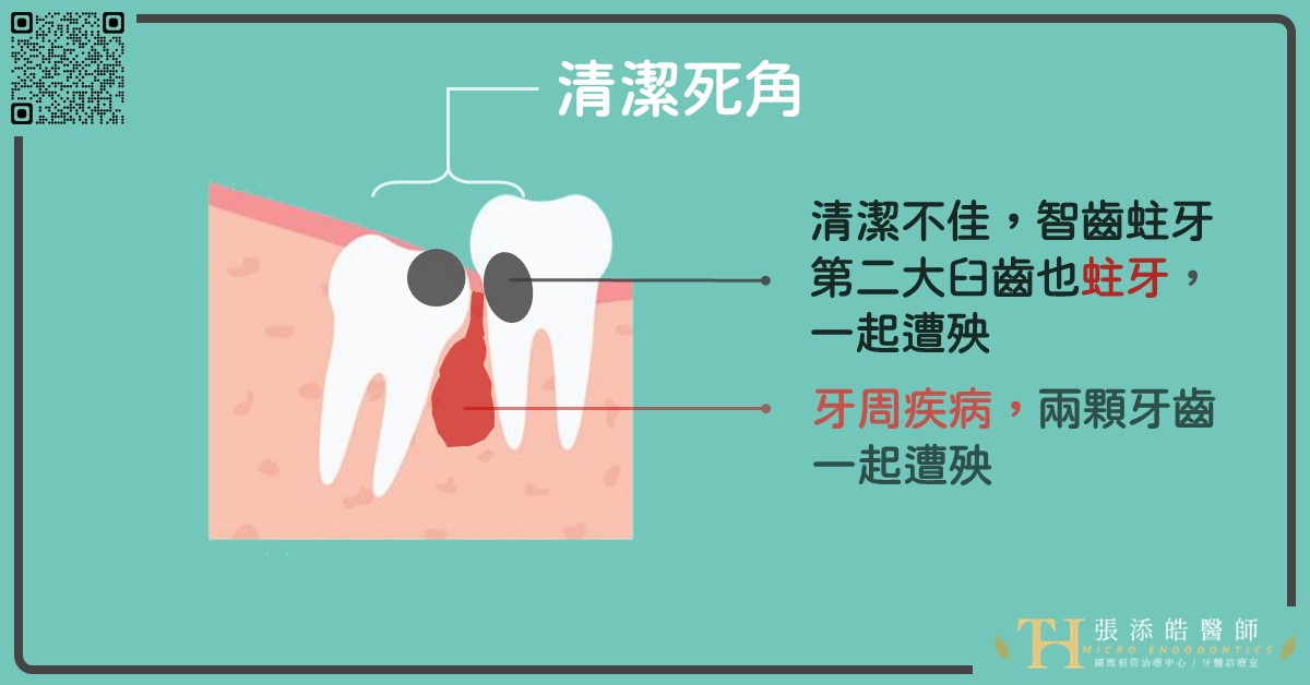 智齒，一定要拔智齒的4種情況。別想在智齒上顯微根管治療呀
