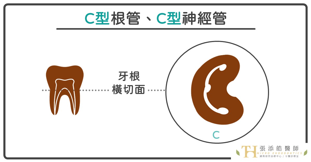 困難顯微根管治療。C型根管，你可以做的3件事情【張添皓顯微根管治療案例、小故事】