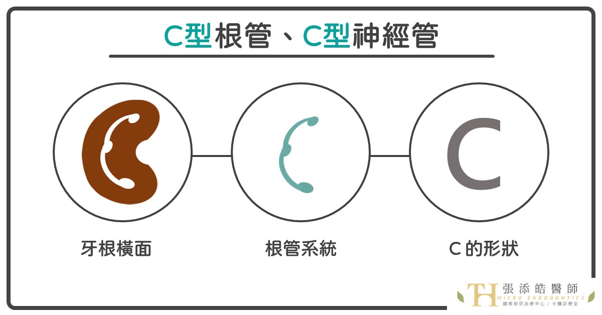 困難顯微根管治療。C型根管，你可以做的3件事情【張添皓顯微根管治療案例、小故事】