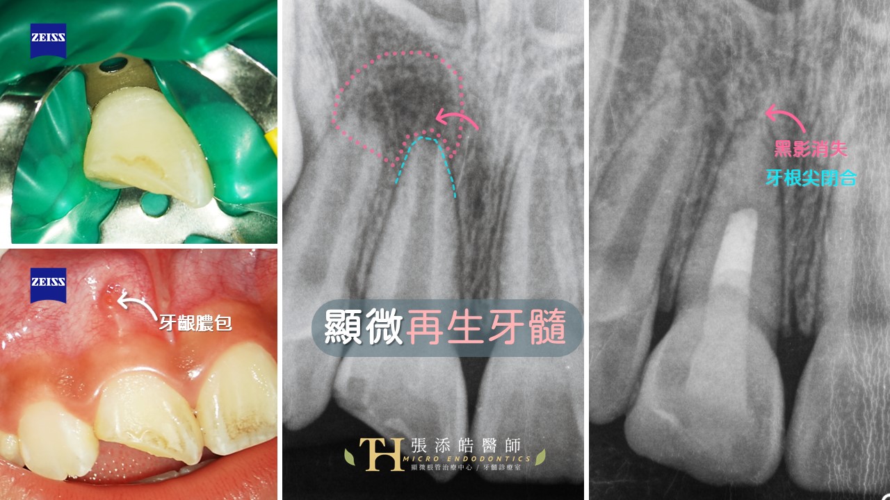 再生性根管治療、再生牙髓、牙髓再生。張添皓顯微根管治療