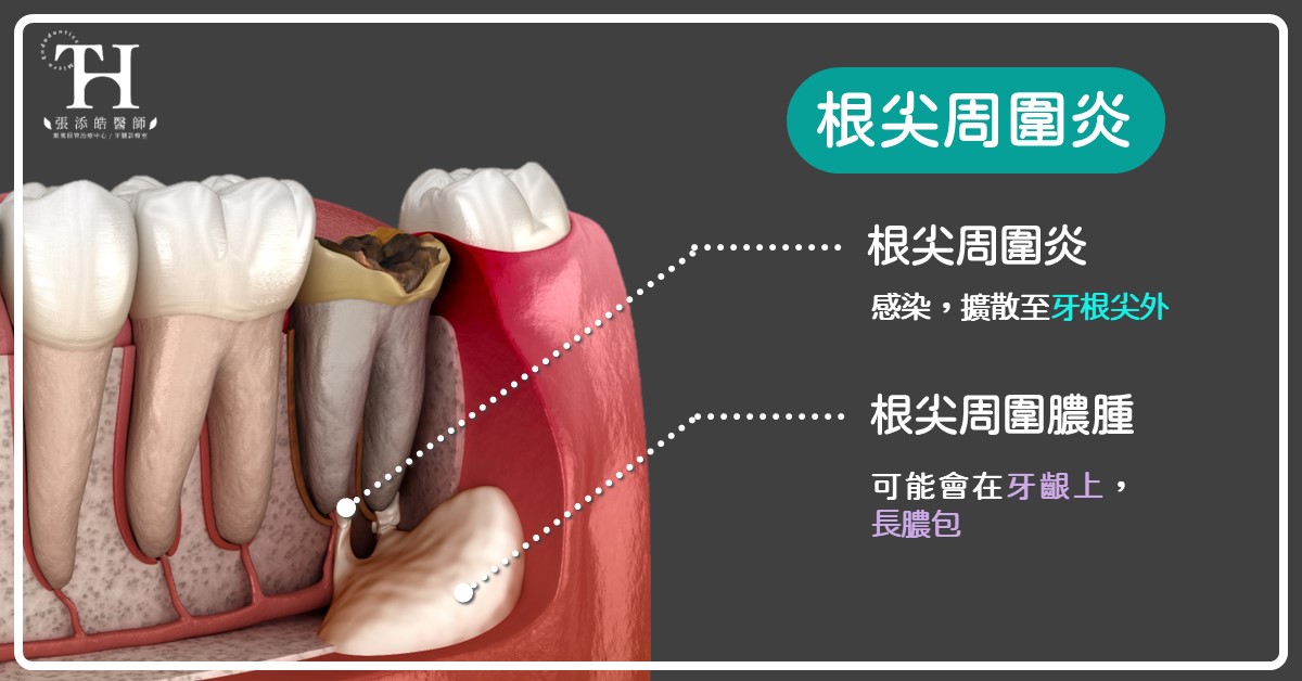 根管治療後，仍牙齒痛的常見4原因，抽完神經還痛？