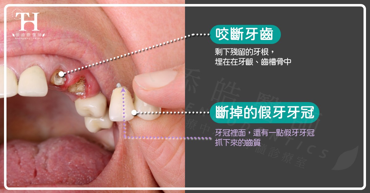 牙裂、裂齒有救嗎？要拔牙嗎？張添皓顯微根管治療