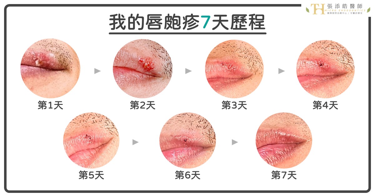 唇皰疹，會有什麼症狀？命運三部曲：發病、躲藏、再發