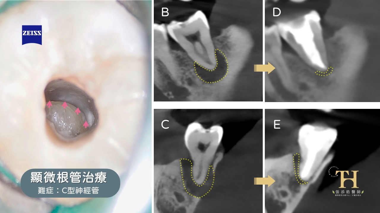 牙齦膿包、但不痛；牙髓壞死。困難C型根管顯微根管治療【顯微根管治療案例、小故事】