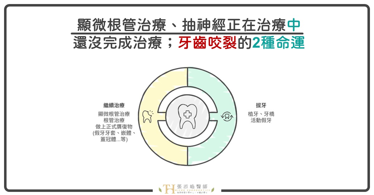 顯微根管治療、抽神經正在治療中，還沒完成治療；牙齒咬裂的2種命運